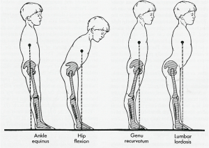 toe walking pathology